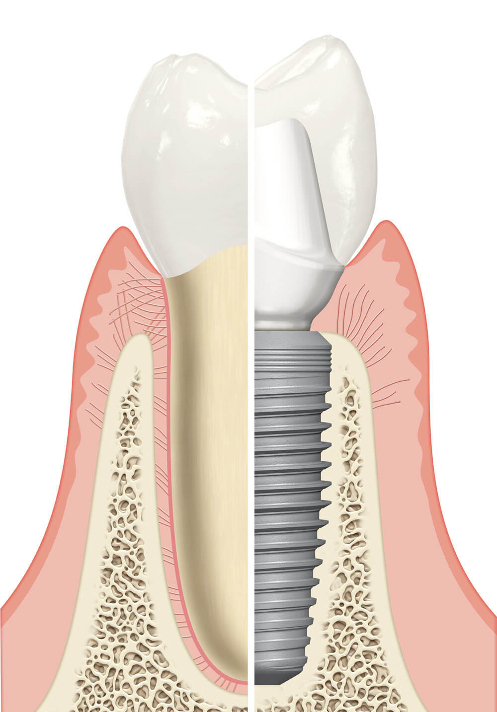 One Visit Dental Crown Napier | Dental Implants Hawkes Bay